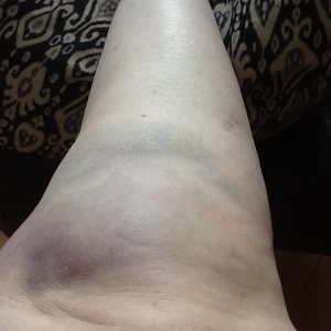 This is a picture of my poor knee, twice as large as usual.